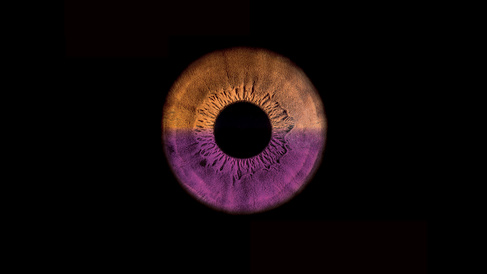 Eye with top half orange and bottom half purple